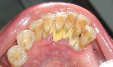 Пример зубного камня