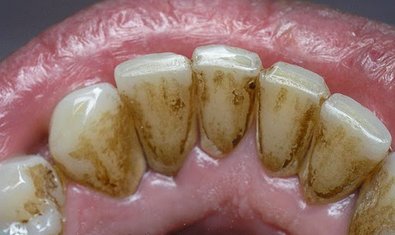 Пример зубного камня