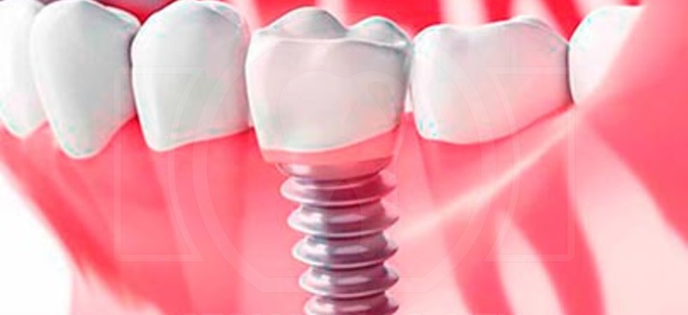 Что важно учитывать при имплантации зуба