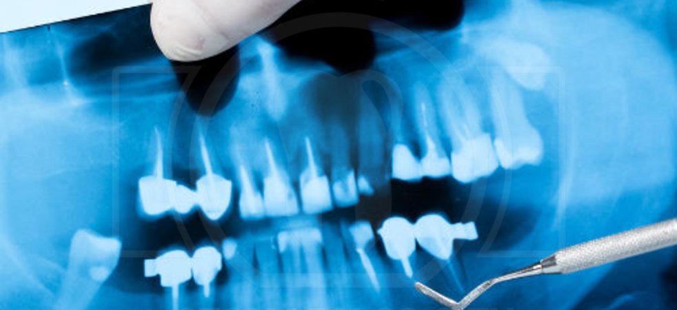Изучаем различные виды рентгеновских снимков зубов