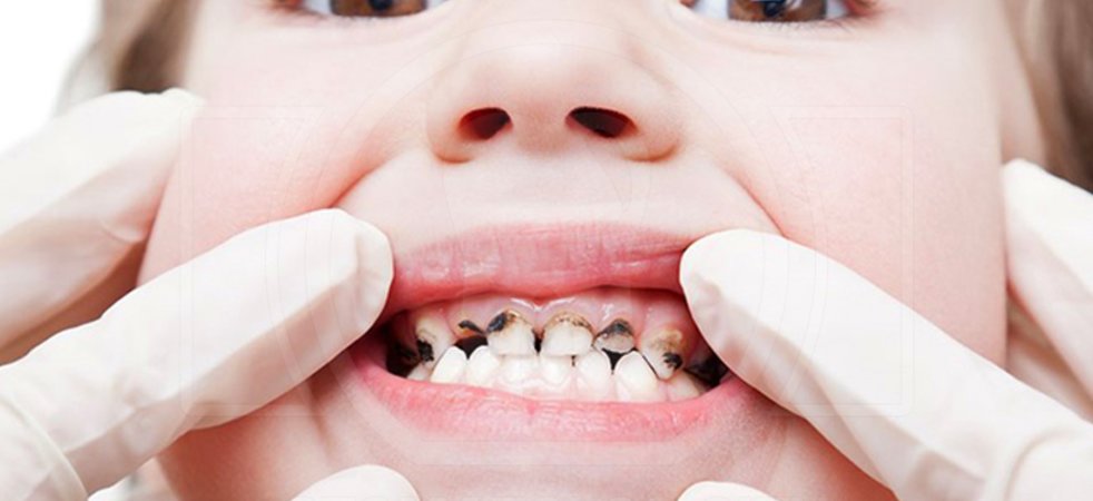 Кариес молочных зубов: причины, стадии и лечение