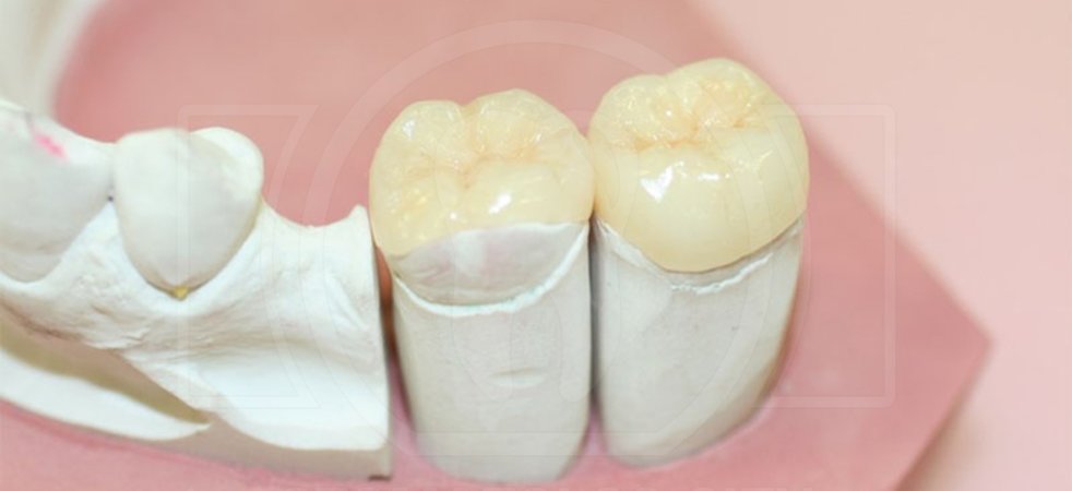 Керамические вкладки как лучший способ реставрации зубов