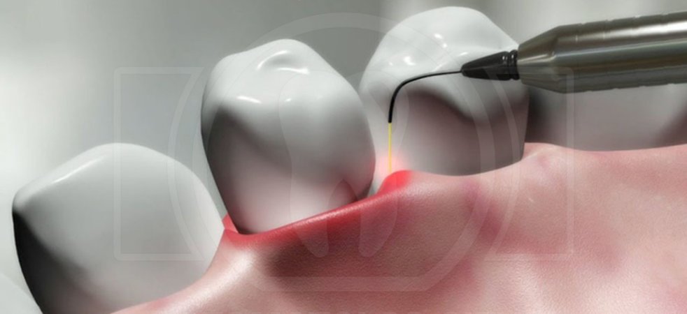 Лазерное лечение в стоматологии
