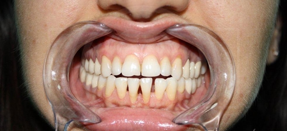 Оголение корней зубов