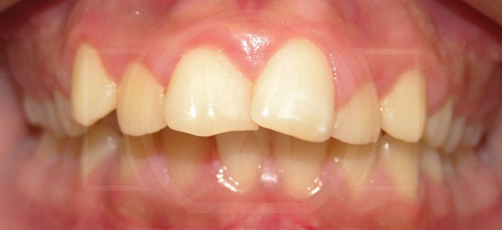 Зуб развернулся внутренней стороной к соседнему зубу при заболевании десен: что делать?