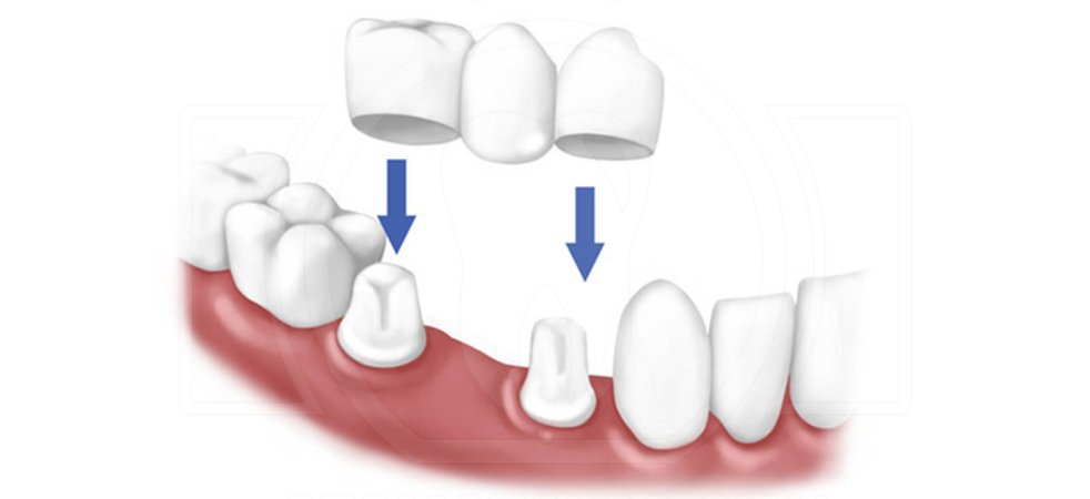 «Зубной мост» или что такое мостовидные зубные протезы?