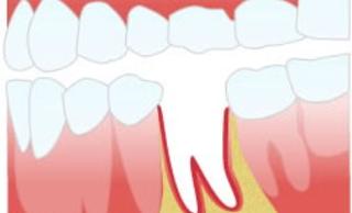 Альвеолит лунки после удаления зуба