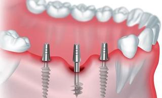 Базальная имплантация зубов: особенности, преимущества, методы установки