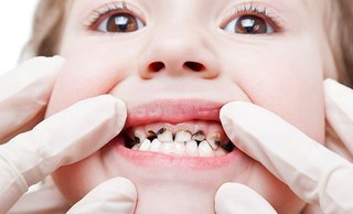 Кариес молочных зубов: причины, стадии и лечение