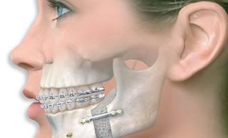 Компактостеотомия в области одного зуба (при ортодонтическом лечении)