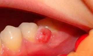 Лечение гранулемы зуба