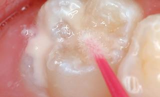 Герметизация фиссур зубов у детей