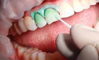 Лечение кариеса молочного зуба методом инфильтрации «Icon»