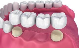 Мостовидные протезы зубов