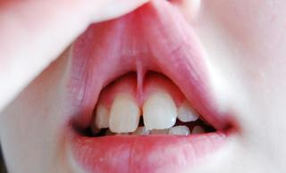Пластика уздечки губы, языка