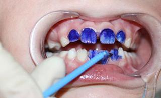 Серебрение молочных зубов детям