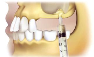 Синус-лифтинг (наращивание костной ткани) при имплантации зубов