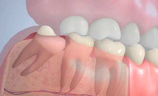 Удаление зубов мудрости: что нужно знать о процедуре и возможных осложнениях