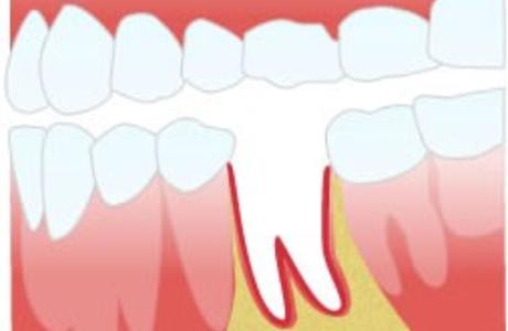 Альвеолит лунки после удаления зуба