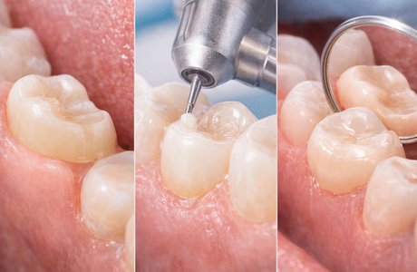 Клиновидний дефект: пломба чи накладка? Простими словами про причини, лікування і профілактику Клиновидний дефект: пломба чи накладка? Простими словами про причини, лікування і профілактику