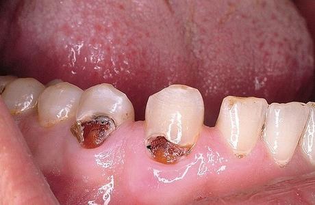 Лечение пришеечного кариеса зуба