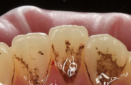 Налёт на зубах (зубной камень): виды и причины