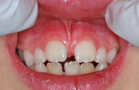 Пластика уздечки верхней губы и языка детям
