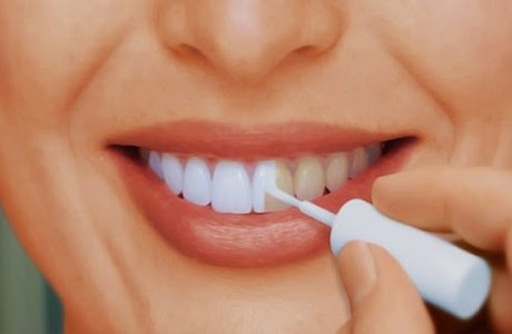 Почему отбеливание зубов дома может стоить вам здоровья: Советы стоматолога