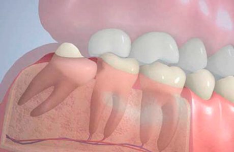 Удаление зубов мудрости: что нужно знать о процедуре и возможных осложнениях